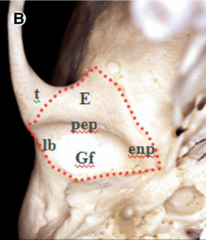 Resim 2. Temporal kemikteki ve kondildeki kapsülün yapışma bölgeleri 1.5.DİSCUS ARTİCULARİS Discus articularis; fibroelastik kıkırdaktan yapılmış olup, eklem boşluğunda bulunur.