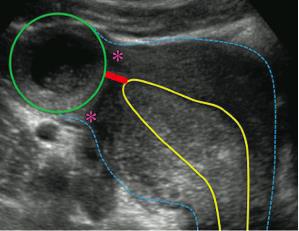 Myometrial