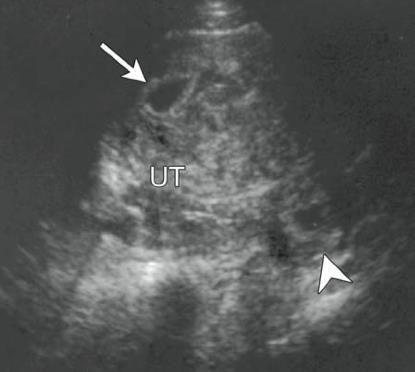 Heterotopik gebelik 1/3800, IVF te 1/100 İntrauterin gebelik + adneksiyal