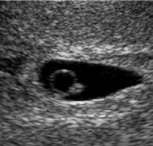 Embriyo 6 hafta (3-4 mm)