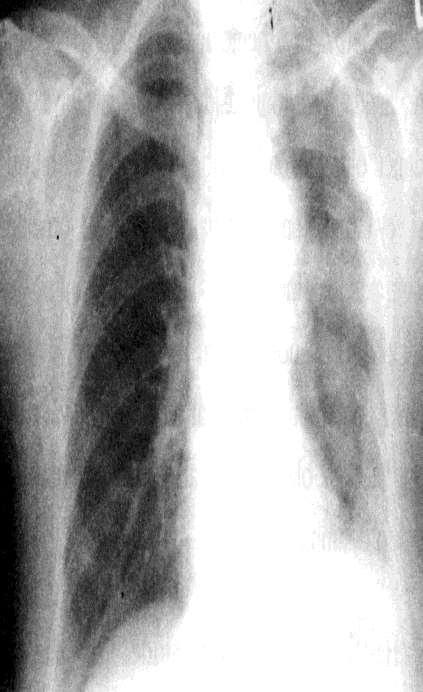 60 yaş, Erkek hasta, asbest maruziyeti İki ayda solda künt göğüs ağrısı Eforla nefes darlığı Sol alt sinüsü