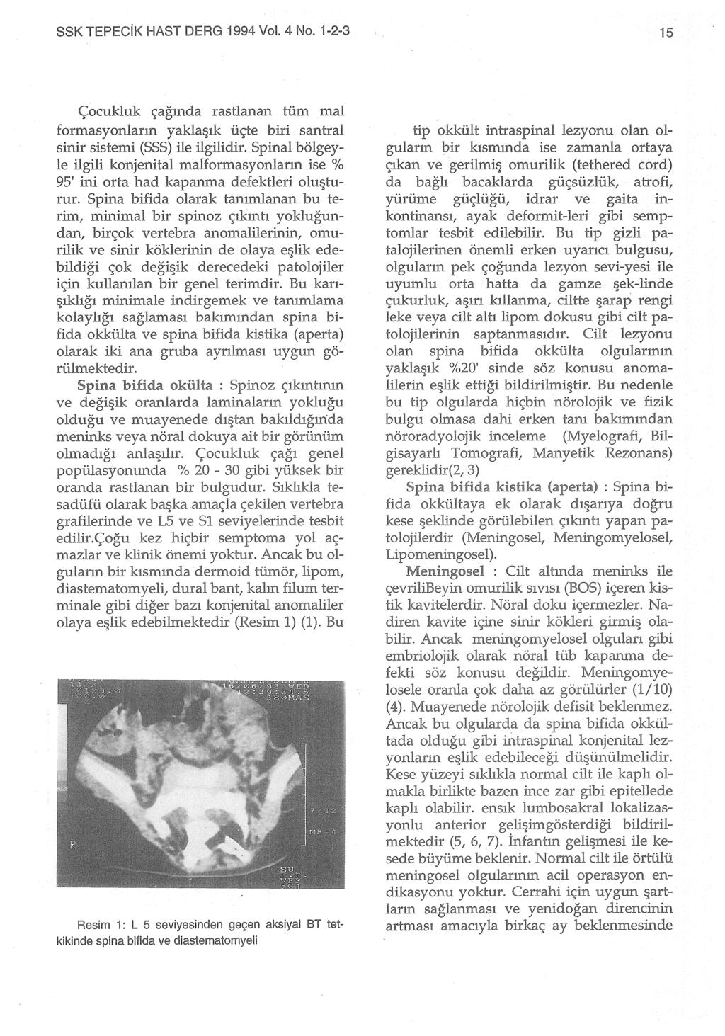 SSK TEPECiK HAST DERG 1994 Vol. 4 No. 1-2-3 15 Çocukluk çağında rastlanan tüm mal formasyonların yakla~ık üçte biri santral sinir sistemi (SSS) ile ilgilidir.