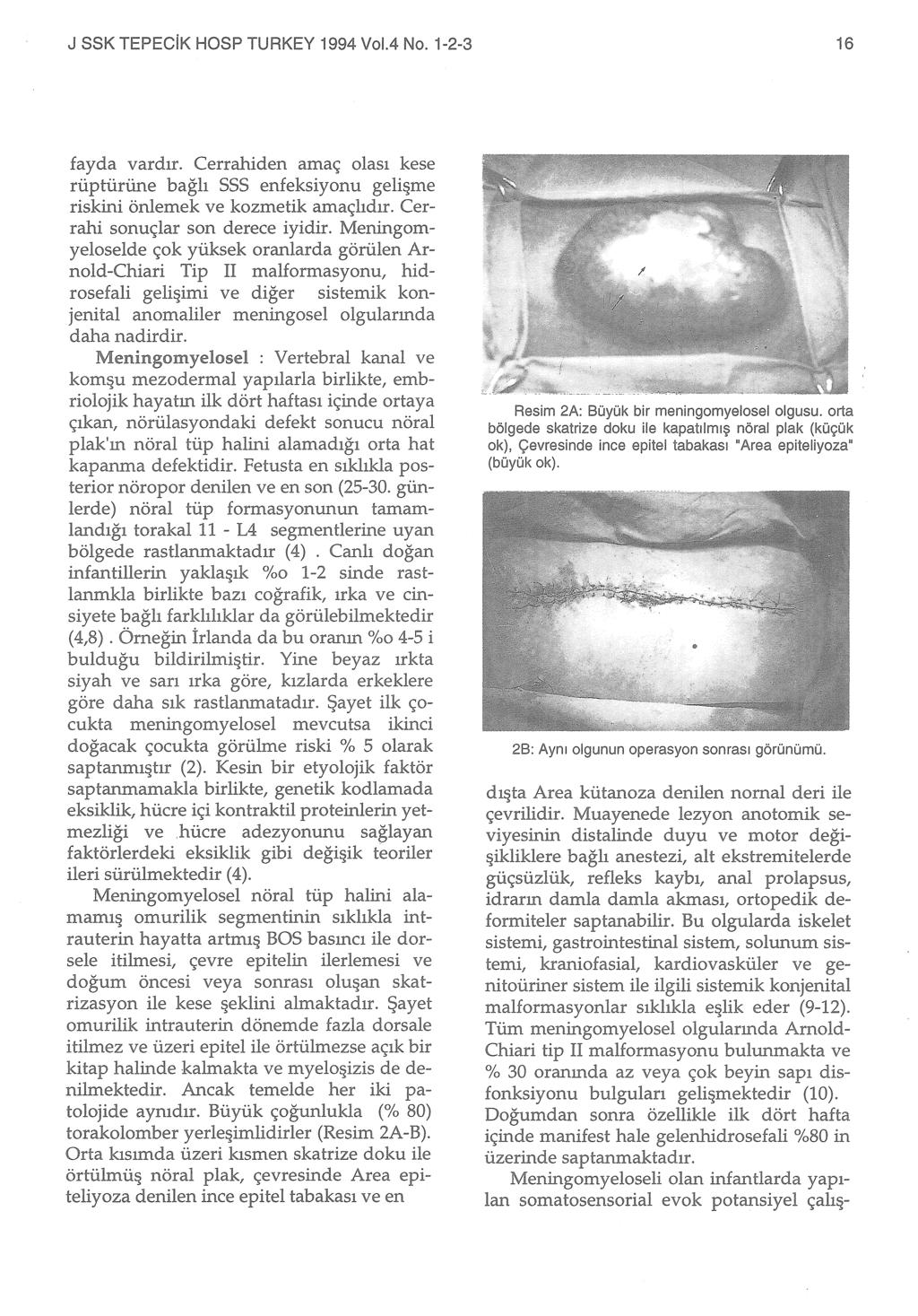 J SSK TEPECiK HOSP TURKEY 1994 VoL4 No. 1-2-3 16 fayda vardır. Cerrahiden amaç olası kese rüptürüne bağlı SSS enfeksiyonu gelüıme riskini önlemek ve kozmetik amaçlıdır.