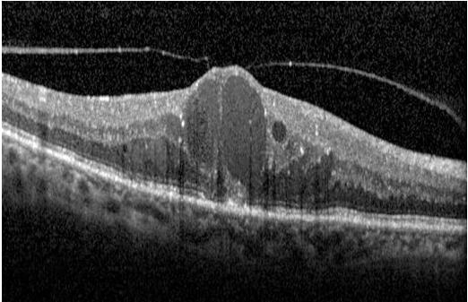 (%79.9) ise belli bir alanda yoğunlaşma olmadan retinanın tüm katmanlarına dağılmış olarak izlendi. Resim 6. Hiperreflektif nokta varlığını gösteren OCT kesiti 4.