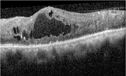 Ortalama SFK değeri KMD-H grubunda 525±137µm, KMÖ-H grubuna (435±109µm) göre anlamlı derecede daha yüksekti (p=0,0001).