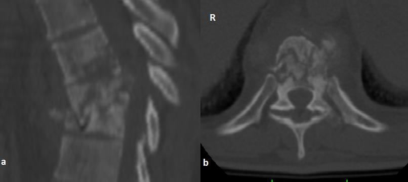 Resim 2: Pott hastalığına bağlı T8 ve T9 kırığı sagittal (a) ve axial (b) BT görüntüleri Resim 3: Pott hastalığına bağlı T8 ve T9 kırığı sagittal (a) ve axial (b) kontrastlı MRG görüntüleri