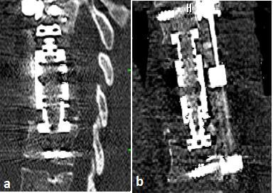 Resim 4: Anterolateral korpektomi, korpektomi kafesi uygulaması ve lateral plaklama sonrası sagittal (a) ve coronal (b) BT görüntüleri Devredilirken hastanın