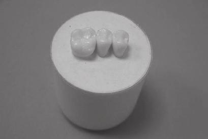 110 Birinci aşamada, öğrencilerden üst sol 4, 5, 6 numaralı plastik dişlerin kontaklı olarak alçı içine alınması ile hazırlanmış modellerde üst sol 5 numaralı dişe MOD amalgam restorasyonu yapılması