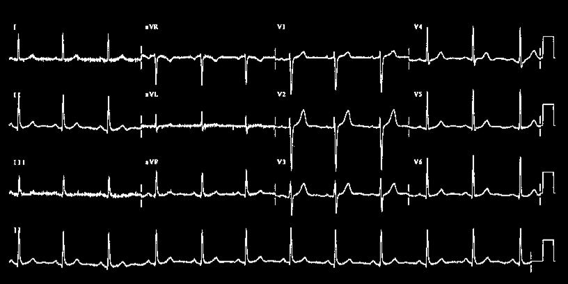 Defibrilasyon