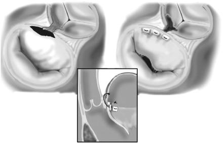 Mitral kapak eksploras-yonu interatriyal oluk üzerinden yapılan sol atriyotomi ile sağlanır. Makroskopik olarak tutulduğu düşünülen tüm doku, onarım kaygısı gözetmeksizin geniş debride edilmelidir.