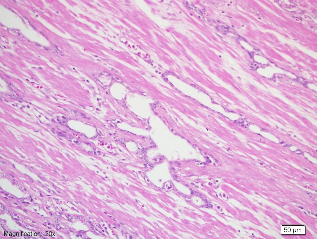 epitel hücrelerinin sitoplazmalarındaki azalma ile karakterlidir (resim 2). Stromal alanda fibrozis de atrofiye eşlik etmektedir.