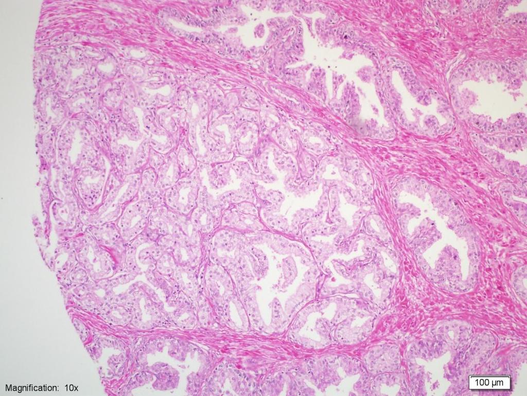 gösteren infiltratif patern de görülebilir. AAH de küçük asinuslar lezyonun periferinde yarımay şeklinde izlenebileceği gibi, daha büyük, kompleks glandlar ile iç içe de olabilir.