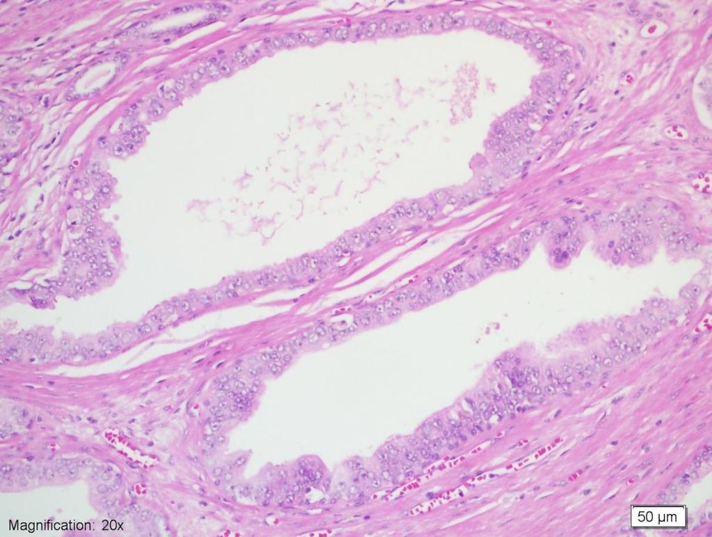 Resim 6: HG-PIN odağı, belirgin nükleollü, veziküler nükleuslu, psödostratifiye glandlar (H&E 200x) 2.5.2 Prostatik adenokarsinom: Prostat malignitelerinin yaklaşık %95 ini oluşturmaktadır (44).