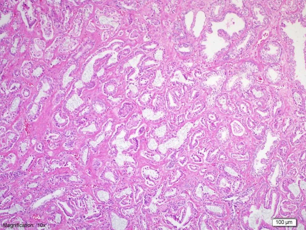 Resim 7: Gleason Grade 3 adenokarsinom odağı, düzensiz sınırlı, infiltratif paternde, iyi gelişmiş tümöral glandlar (H&E 200x) Patern 4: Kaynaşmış mikroasiner glandlar, sınırları net seçilemeyen