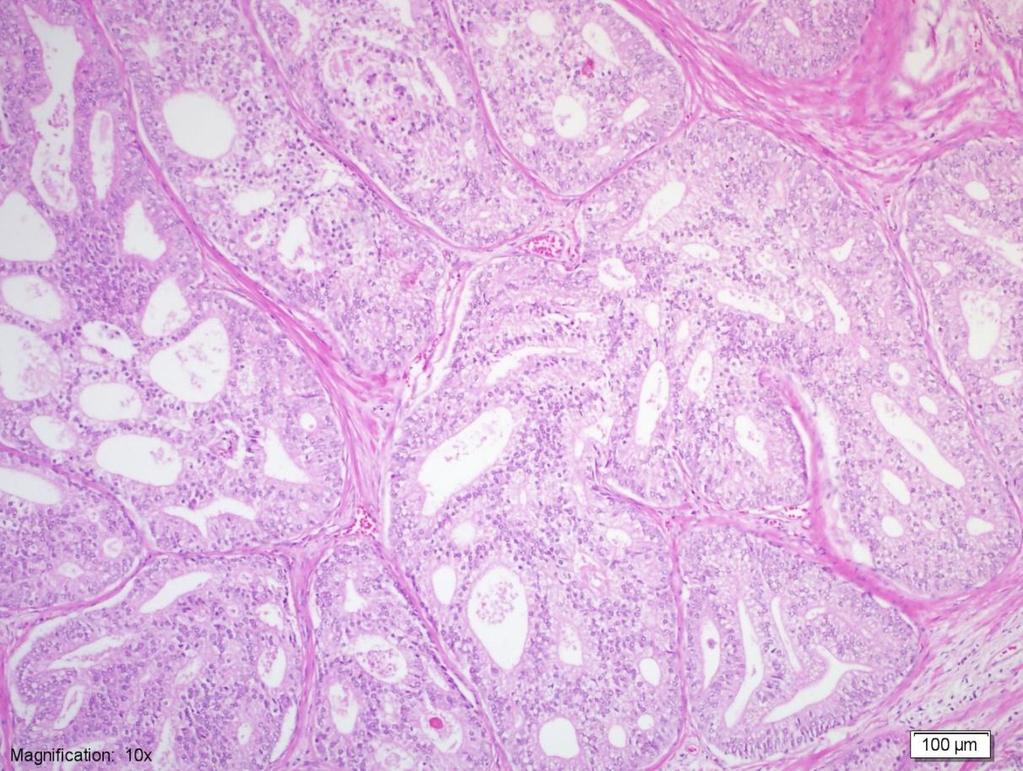 Resim 8: Gleason Grade 4 adenokarsinom odağı, ekspansil, kribriform glandlar (H&E 100x) Patern 5: Glandüler diferansiyasyonun çok az ya da hiç izlenmediği, solid tabakalar, kordonlar