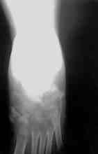 Demiralp ve ark. Orta ayak bölgesi çok parçal k r klar n n distraksiyon osteogenezi ile tedavisi 133 sonra y lda bir radyografik kontrolleri yap ld.