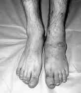 Hastalar n tamam nda SEF cihaz n n ç kar lmas - n n ard ndan azalm fl olan ayak bilek hareketleri birinci ay n sonunda tamamen düzeldi.