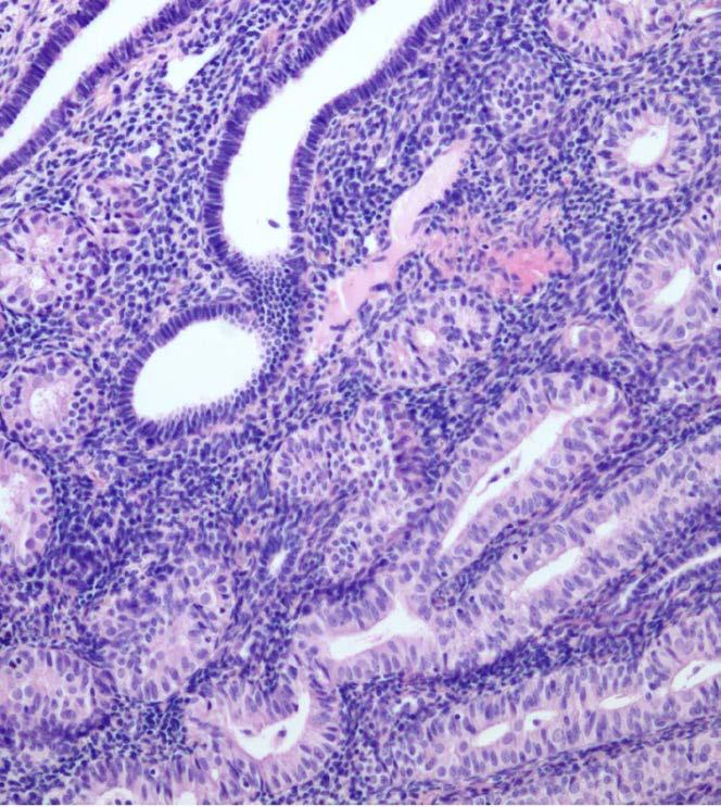 EIN kriterleri (1) Gland alanı > stroma; (2) Lokalize lezyonda kalabalıklaşmış gland epitelleri sitolojik olarak zemindekilerden farklı; (3) Yapısal ve