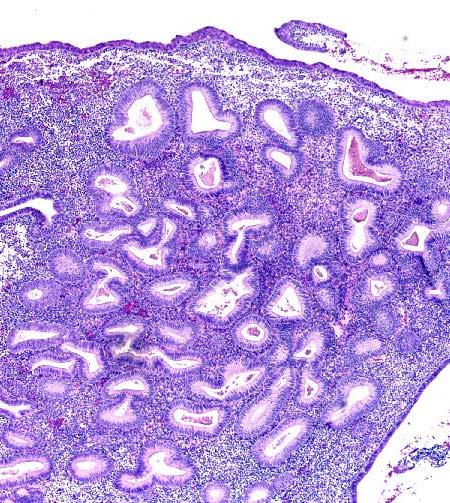 Klasifikasyon EIN (Endometrial İntraepitelial Neoplazi) 2000 o Benign Benign hiperplazi (BH) o