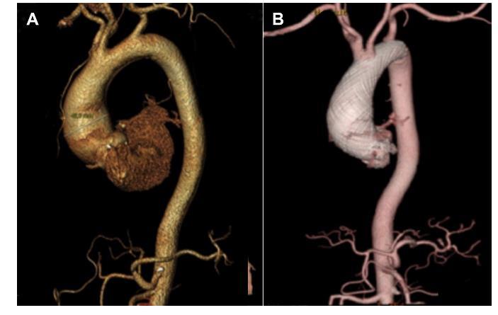 Resim 15. Asendan aort anevrizmalı olguda akım çevrici stent uygulaması öncesinde ve 9 ay sonrasında kontrol 3B BT anjiografi görüntüsü (36)