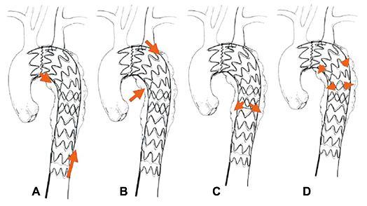 Resim 16. Endoleak tiplerinin şematik gösterimi (A: tip1, B: tip 2, C: tip 3, D: tip 4) (85) Aortanın dallarından retrograd olarak anevrizmanın doluş göstermesine tip 2 kaçak adı verilir.