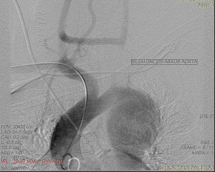 karotikokarotid by-pass cerrahisi uygulanan, arkus aorta distalinde