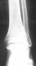 The results of surgical management of ankle fractures 2A 2B 2C 2D Resim 2A: 37 yaşında erkek hastanın ameliyat öncesi ayak bileği ön arka radyografisi görülmekte.