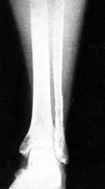 Medial eklem aralığı 4 mm den daha fazla olan kırıklarda sindesmoz ve deltoid ligaman yaralanmasının geliştiği bildirilmiştir. [1,2] Çalışmamızda, 26 olguda (%65) (16 olgu (%61.5) Tip B, 10 olgu (%38.