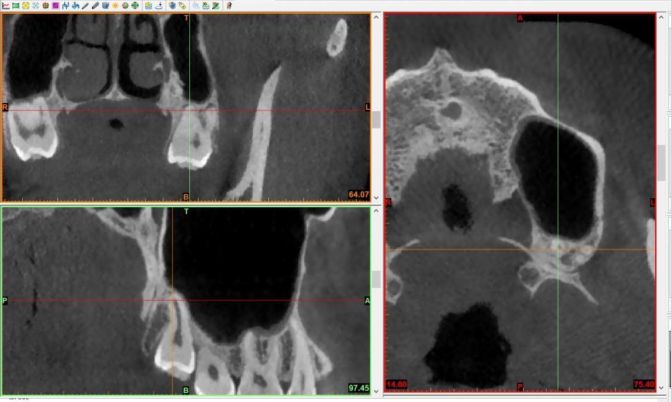 Şekil 3. 8. Aksiyal, koronal ve sagittal görüntüleri üzerinde gömük dişin kök gelişiminin incelenmesi 3.6.