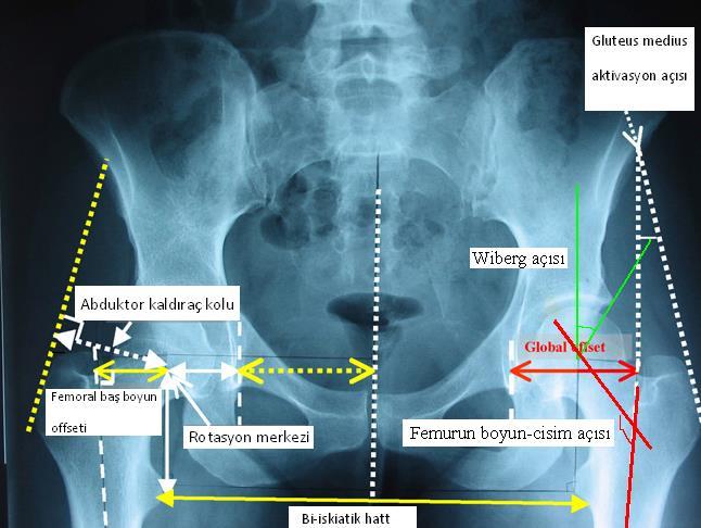 Şekil 1: Kalça ekleminin radiolojik değerlendirilmesi. 2.2.2 Pelvik kemik anatomisi Os coxae: Sağ ve sol os coxae pelvik kuşağı oluşturan ana kemik yapılar olarak bilinir.