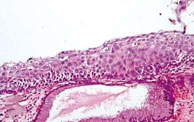 Servikal sitoloji ve biyopsi tanıları arasında yapılan sitohistolojik korelasyon çalışmalarında uyumsuzluklar olabilmektedir.