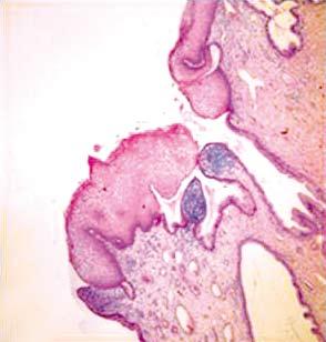 yeşil c et al: Premalignant Lesions of the Cervix A B C D Şekil 2: Sonradan değerlendirmede LSIL tanısı alan olgular.