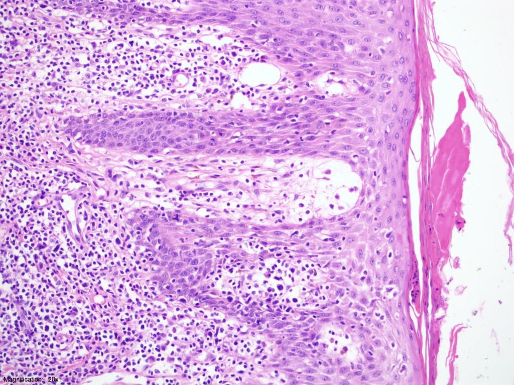 Resim 3: Epidermotropizm gösteren atipik lenfositler