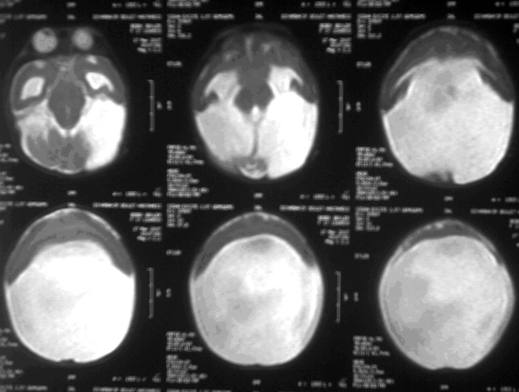 Resim 2. Hastanın kranyal magnetik rezonans görüntüleri. kül, bazal gangliyonlar, kapsüler formasyonlar ve korpus kallozum izlenemedi (Resim 2).