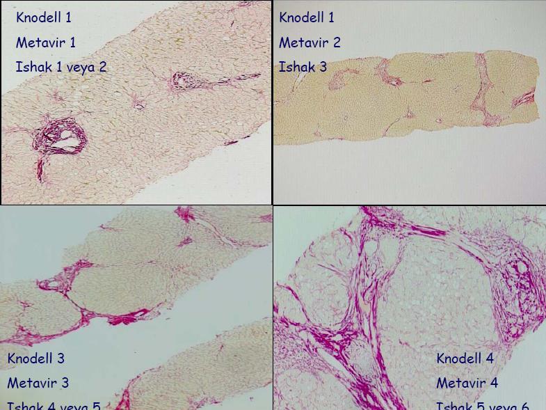 Fibrozis KNODELL METAVİR ISHAK (modifiye Knodell) 0 F0 0 1 F1 1 3 F2 F3 2 3 4 5 4