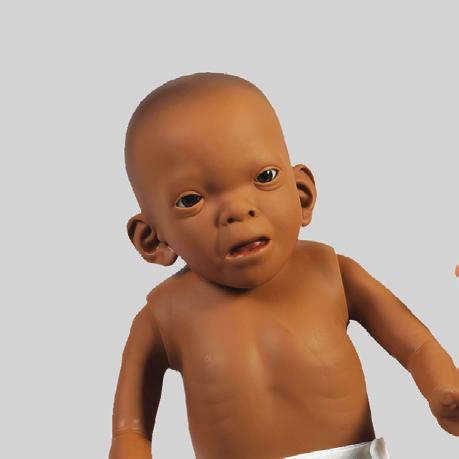 Bu bebeğin özellikleri şunlardır: Küçük baş çevresi Dar göz açıklıkları Düzleşmiş surat Burun ve dudaklar arasındaki belirsizlik İnce üst dudak, küçük kulak anomalileri Paket içeriği Fetal