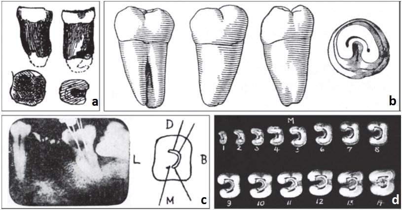 Şekil 2: C şekilli kök ve kök kanallarının tarihsel çalışmalarda tasvirleri. Tüm görüntüler mandibular ikinci molar dişlere dayanmaktadır. Neandertal bireyin diş kökünün şematik çizimi (a).
