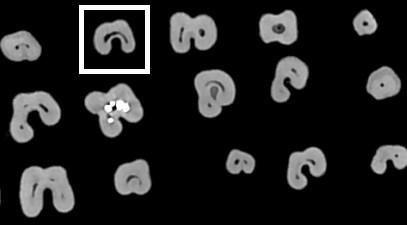 Resim 2: 8X8 FOV alanında görüntüleri alınmış mandibular molar dişlerin aksiyel bir kesiti Resim 3: C1 konfigürasyonuna sahip mandibular molar dişin lingual