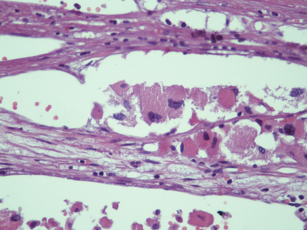 Atipik mitotik figür 3- Venöz invazyon 1- Büyük boyut (>10 cm, >200 gr) 2- Nekroz 3- Kapsüler/sinüzoidal invazyon