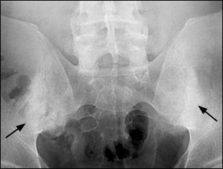 15 2.2.7. Radyolojik Görüntüleme AS nin karakteristik radyografik değişiklikleri eklemlerde ve omurgada diskovertebral, apofizial, kostovertebral ve kostotransvers eklemlerde olur (Şekil 2.5.).