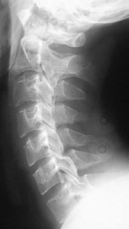 Genel değerlendirme: Tüm yedi vertebra görülmeli, Dört lordotik kavis düzgün olmalı, Vertebral gövdeler, lateral kitleler, laminalar,