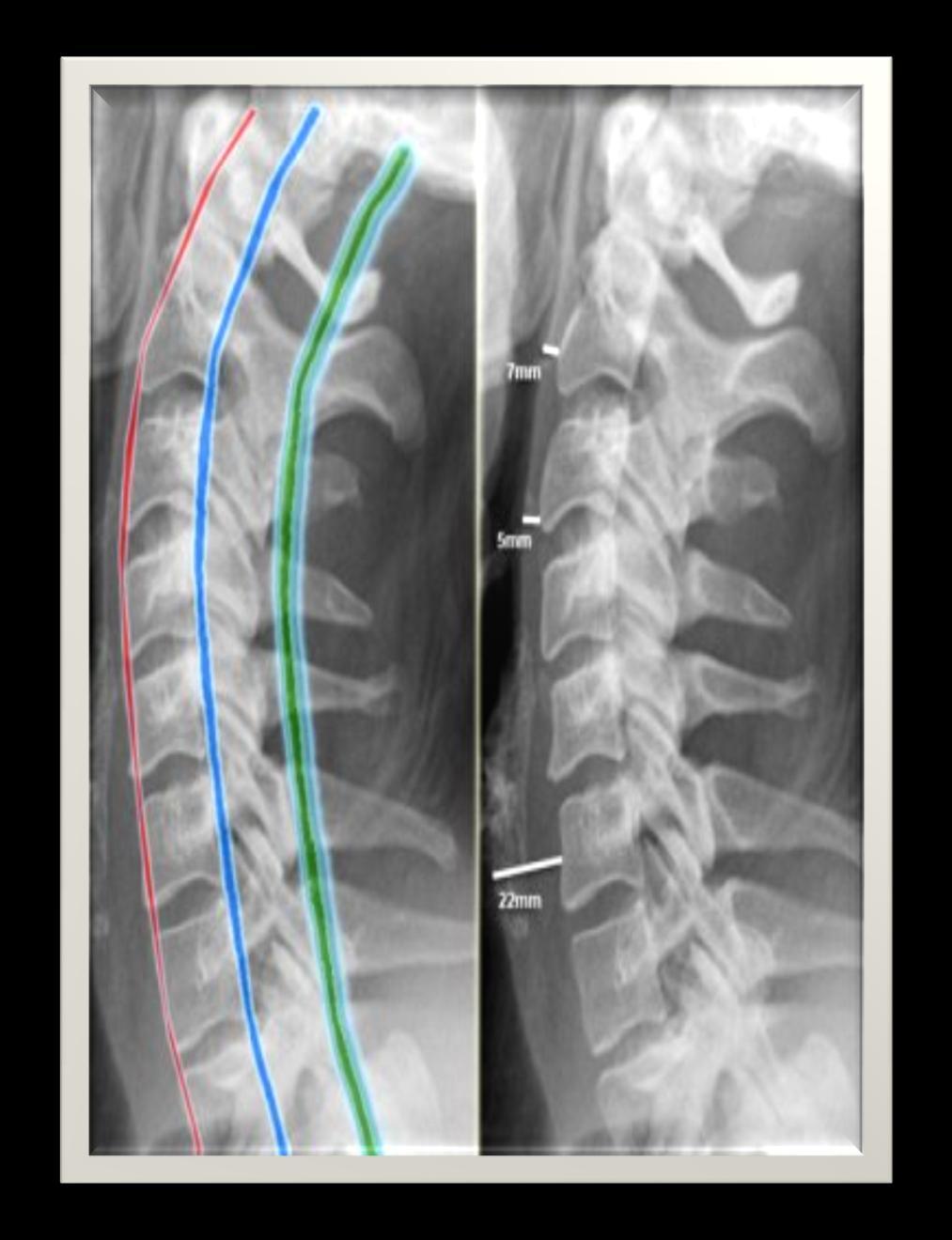 Anterior spinal hat; vertebraların ön yüzeyi boyunca aşağı inen çizgi.