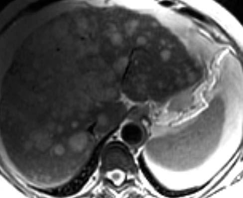 Resim 9. Multipl H odağı. T2 ağırlıklı MR görüntüsünde karaciğer parankiminde çok sayıda değişik boyutlarda hiperintens nodüler lezyon izlenmekte.