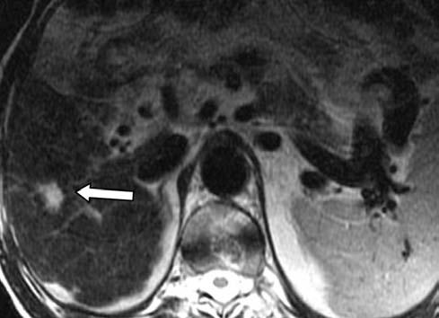 Resim 12. Sirotik karaciğer zemininde hemanjiom (ok). T2 ağırlıklı MR görüntüsünde () düzensiz konturlu hiperintens lezyon, arteryel evrede () tipik periferal nodüler boyanma göstermekte.