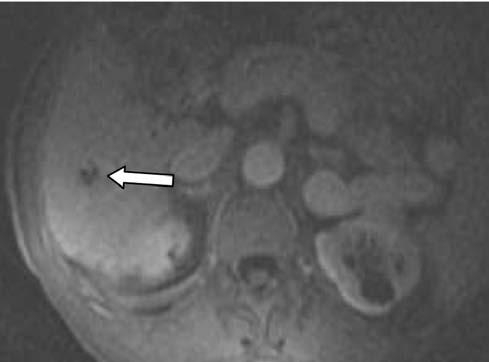 T2 ağırlıklı () ve postkontrast T1 ağırlıklı MR görüntülerinde sirotik karaciğer zemininde sol portal ven komşuluğundaki safra kanalı düzleminde oval kistik lezyon.