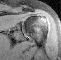 bir yüzünde izlenmektedir (fiekil 14). [1,9,17] Bursal yüz y rt klar nda tendon konturlar düzenini kaybetmifltir ve akromiyon inferiorunda osteofitik de ifliklikler vard r (fiekil 15).