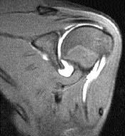 24 Acta Orthop Traumatol Turc Suppl t klarda ve küçük infraspinatus y rt klar nda, MR-A d a rutin olarak kullan lan standart ya bask lamal T 1 - a rl kl üç plan görüntüye ek olarak ABER (abdüksiyon,