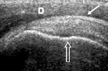 Arkun. Rotator manflet: Görüntüleme 15 fiekil 1. Supraspinatus tendonunun normal US görünümü. (a) Longitudinal (aç k beyaz ok: humerus bafl ; beyaz ok: peribursal ya dokusu; D: deltoid kas).