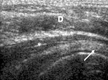 Koronal planda supraspinatus tendonu, tepesi humerus büyük tüberkülünde sonlanan homojen hiperekojen bir yap d r; mediyalde taban akromiyona uzan r.