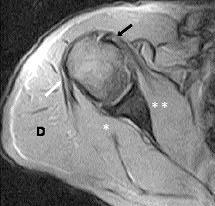 [1,9] Radyolojik olarak rutin MRG ile s n rl bilgi elde edilen durumlarda, omuz eklemi içine paramanyetik kontrast madde verilerek MR artrografi (MR-A) yap lmaktad r.